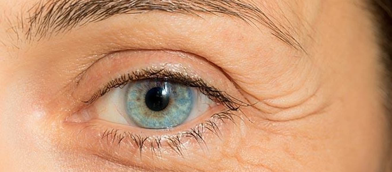 Eκτρόπιο: Τι συμβαίνει όταν το βλέφαρο γυρίζει προς τα μέσα;